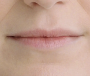 Restylane® patient before receiving lip fillers