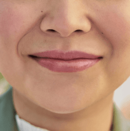 Upclose look at a Restylane® patients' smile