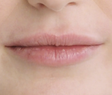 Patient post Restylane® treatment restores volume and definition around their lips. 