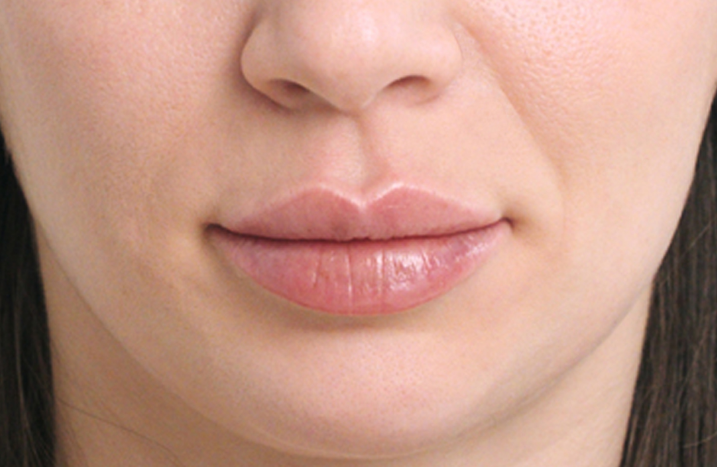 Restylane® patient post Lip filler treatment