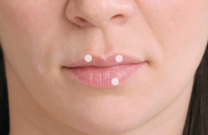 Restylane® patient before receiving lip fillers