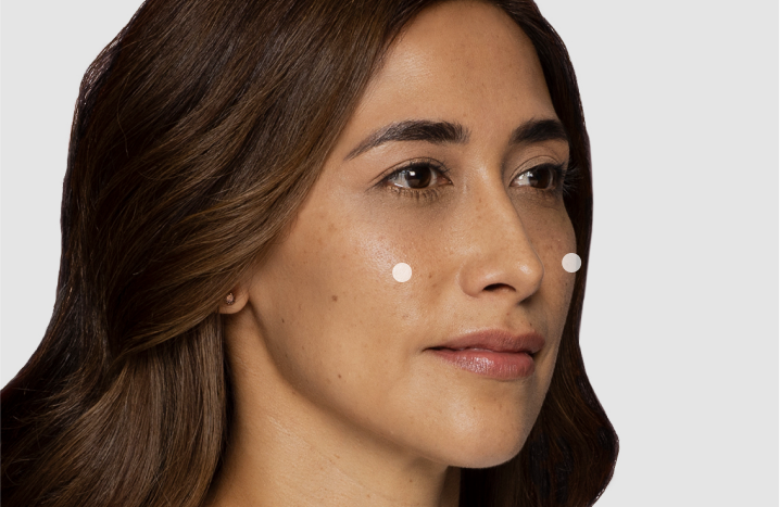 Restylane® Contour: A Natural-Looking HA Cheek Filler