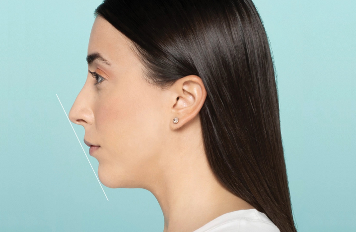 Restylane® patient post her chin enhancement procedure