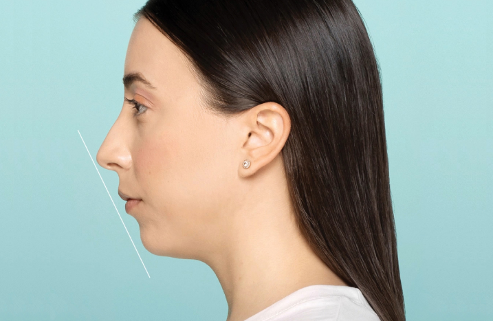 A Restylane® patient prior to her chin filler treatment