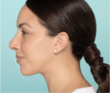 Restylane® patient struggling with chin retrusion