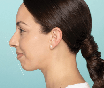 Real patient success reducing chin retrusion