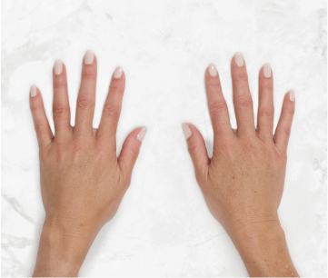 Hands post Restylane® HA fillers look voluminous and youthful