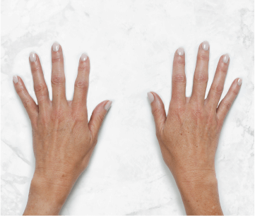 Hands pre-Restylane® treatment lacking volume and vibrance