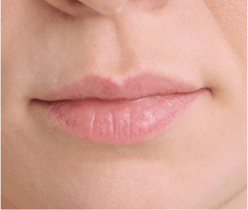 Patient before Restylane® Kyss lip treatment